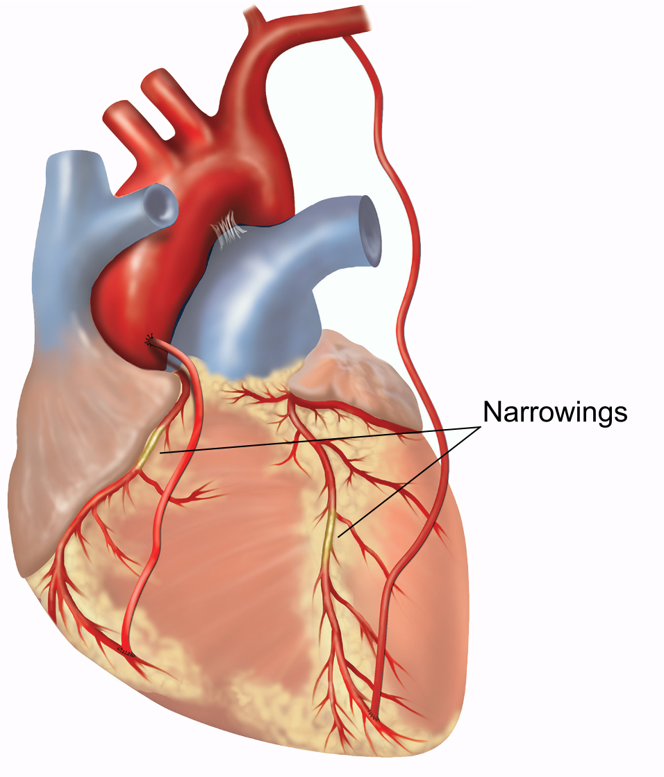 Шунтирование сосудов сердца. Аортокоронарное шунтирование сердца. Аорта коронарное шунтирование. После коронарного шунтирования.