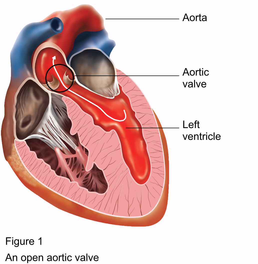 Complications With Aortic Valve Replacement